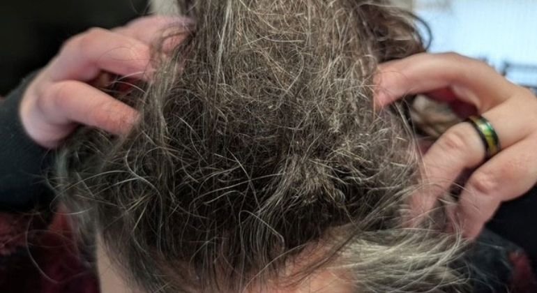What Causes Matted Hair