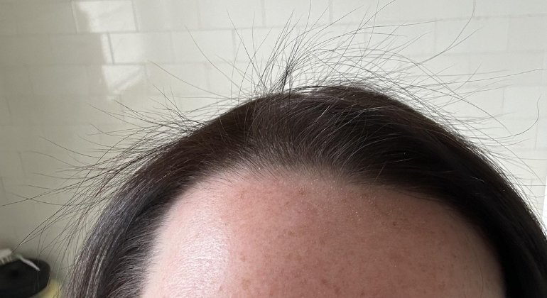 What causes hair breakage at the crown