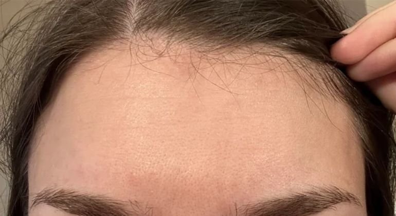 Your forehead donates oil and skincare straight back